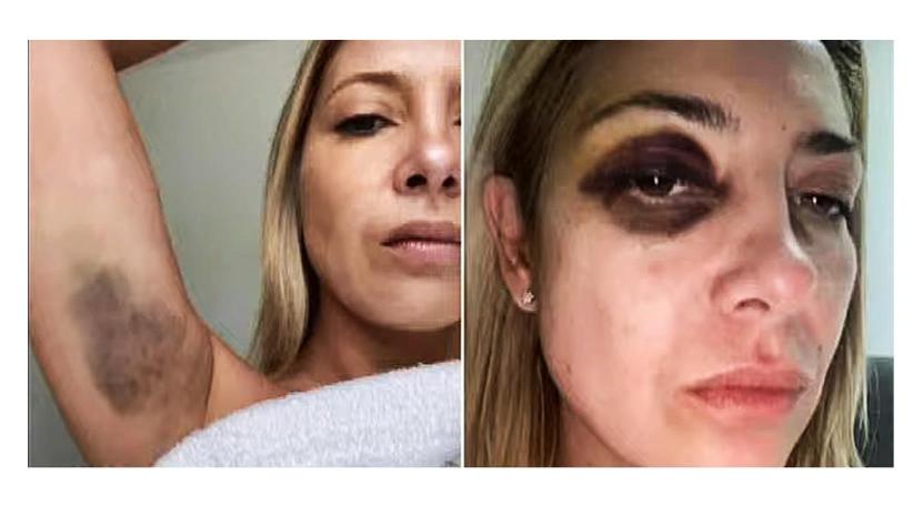 Alberto Fernández envuelto en un escándalo por violencia de género: Revelan las impactantes imágenes de los golpes recibidos por Fabiola Yañez  
